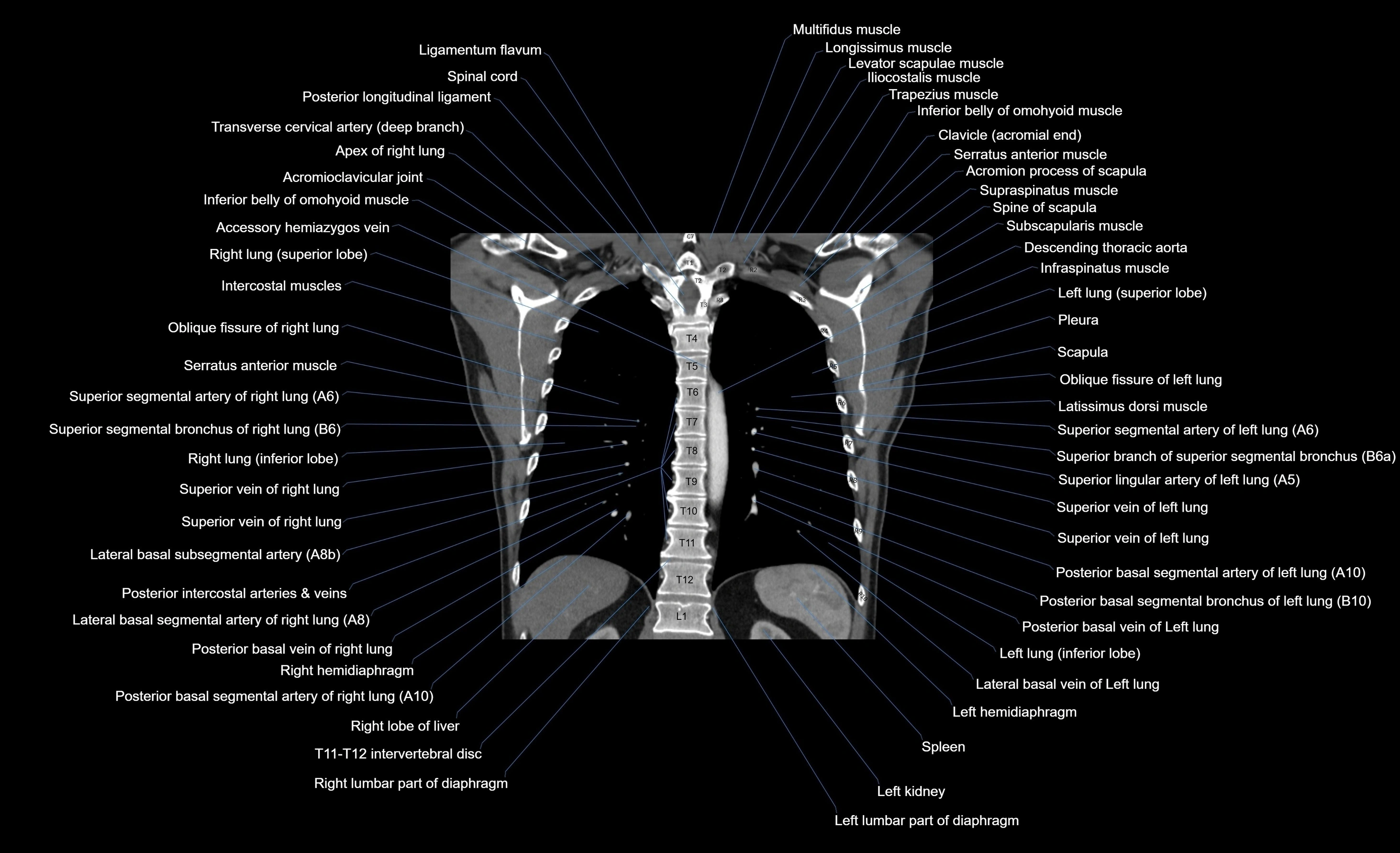 CT chest (thorax) soft tissue window labelled coronal cross sectional anatomy radiology image-00039.webp